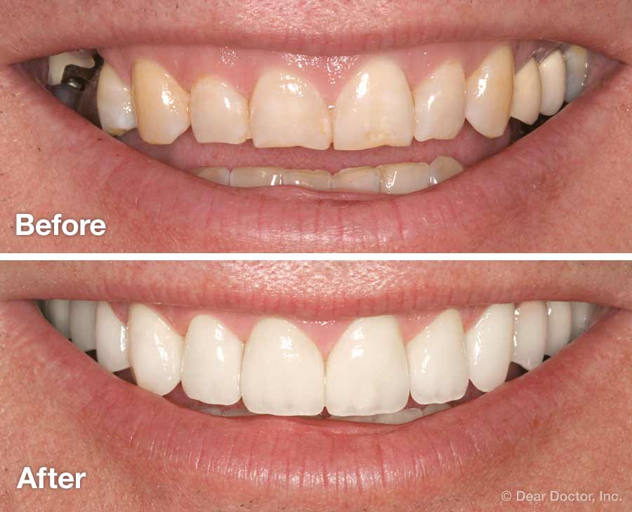 smile-makeover-before-and-after.jpg