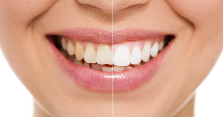 teeth-whitening-services.jpg