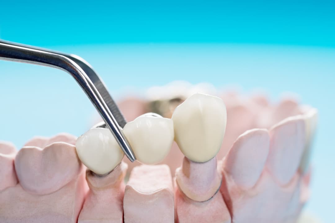 Dental Filling