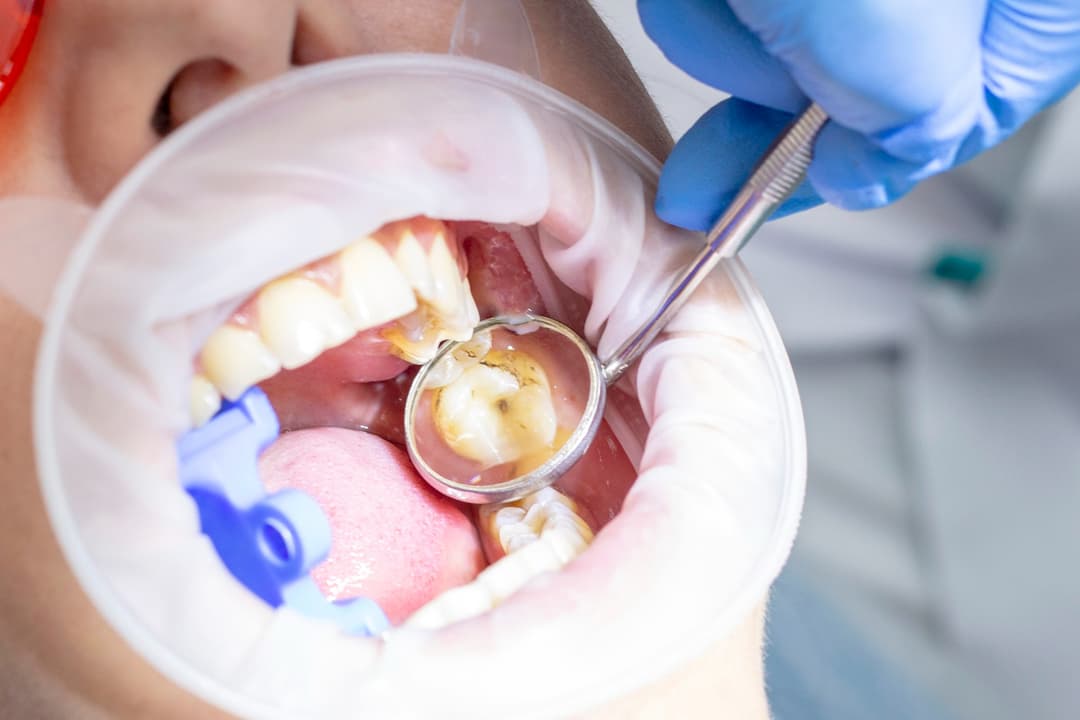 Dental Filling