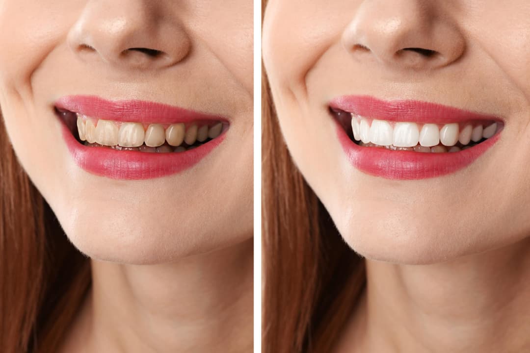 Dental Filling
